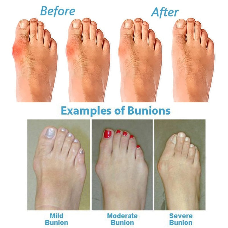 BunionRelief | Orthopedic Correcting Sandals Women